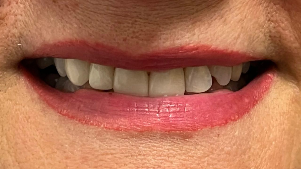 Smile case 4 after treatment at Rovel Dental