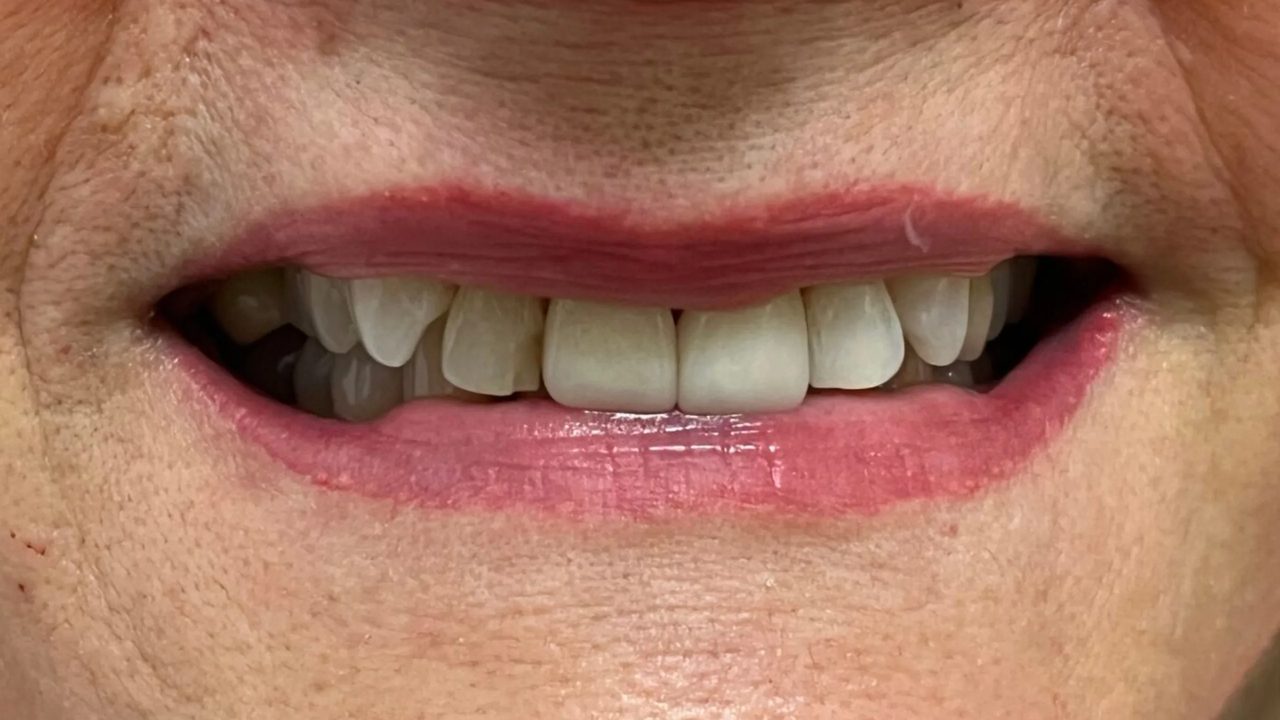 Smile case 4 before treatment