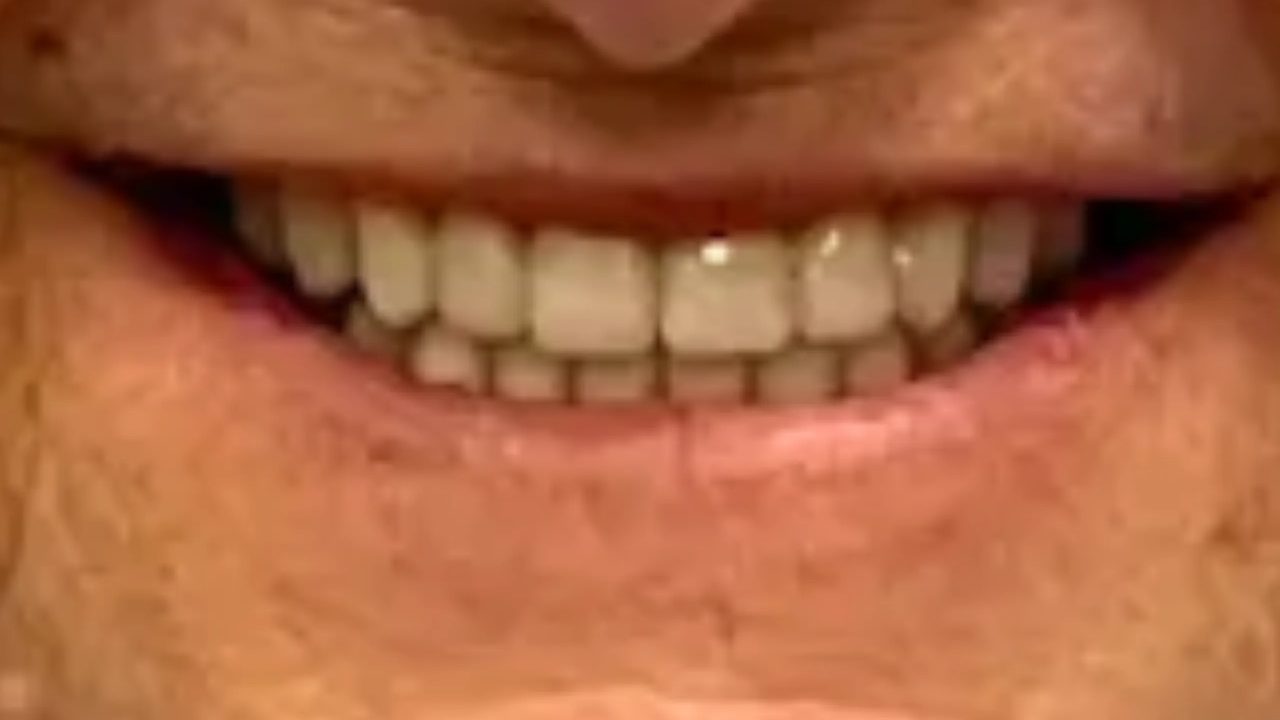 Smile case 9 after treatment at Rovel Dental