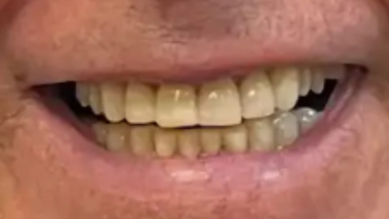 Smile case 12 after treatment at Rovel Dental