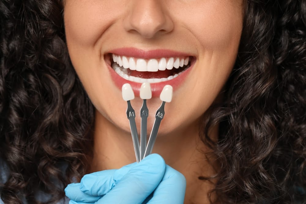 Tooth Shade Selection - Veneers Close-up of a smiling woman’s mouth while a gloved hand holds three tooth shade samples to match her teeth for dental treatment. - Veneers