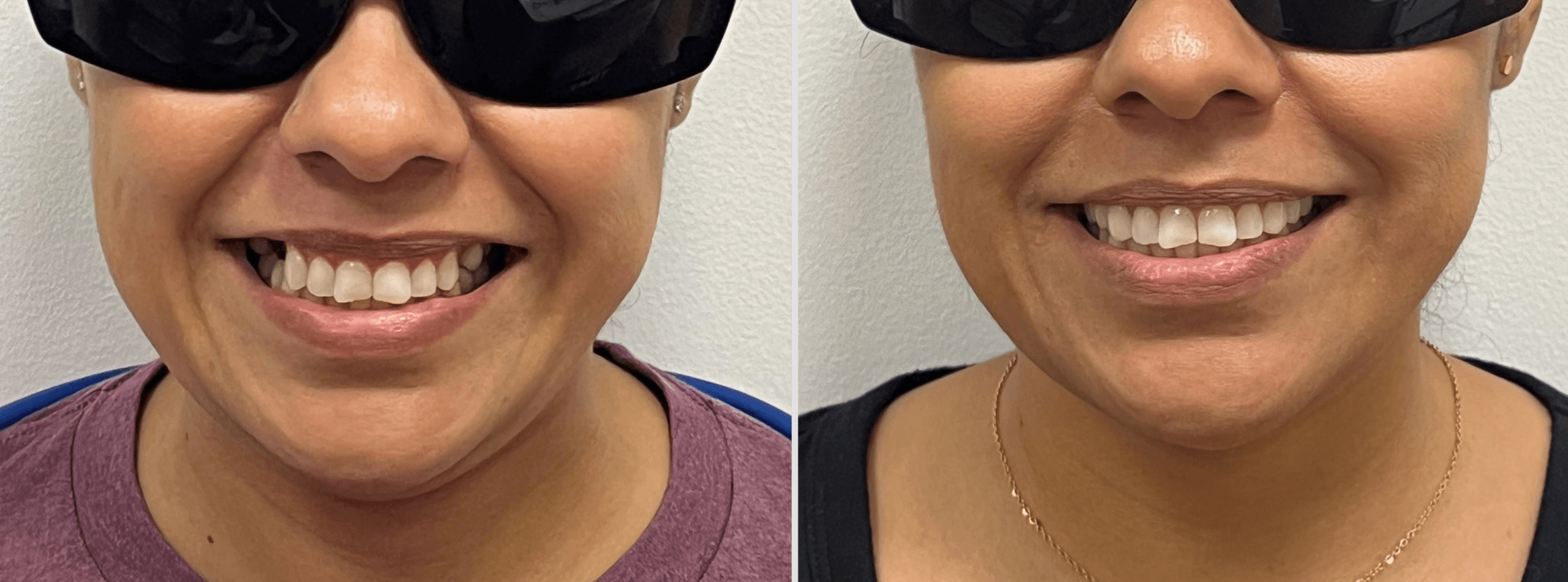 Before and after - Dental Bridges