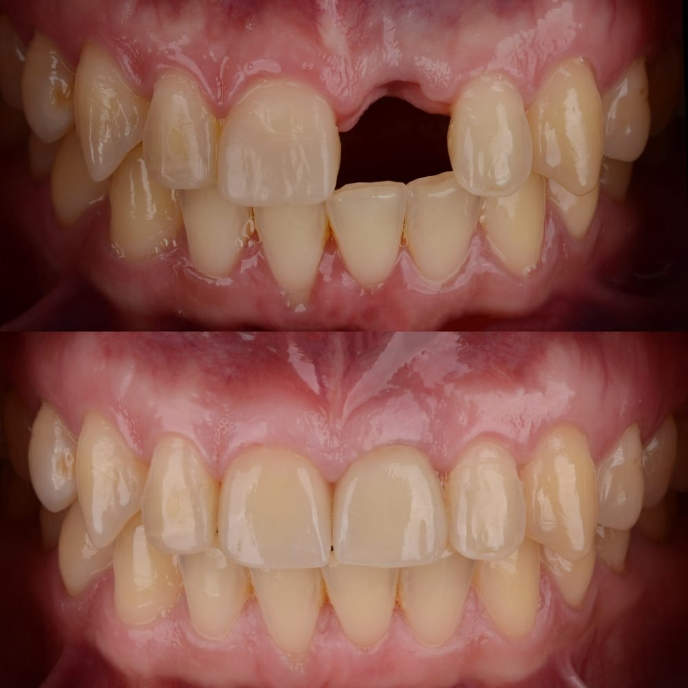 Before and after dental bridge application - Dental Bridges